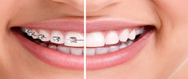 Invisalign