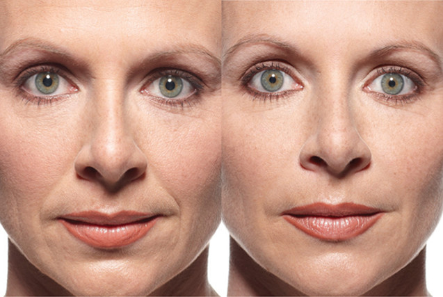 Botox