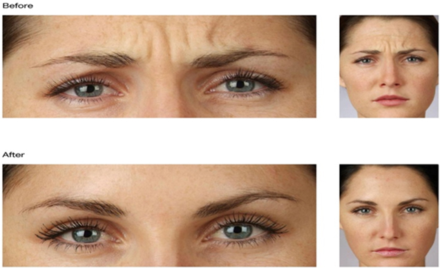 Botox